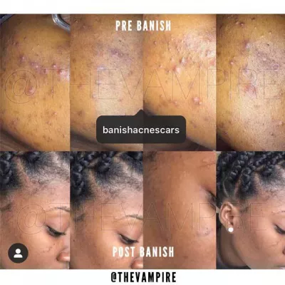 BANISH, le meilleur soin pour les cicatrices d'acn&eacute; ordinaires : Comment enlever les cicatrices d'acn&eacute; &agrave; la maison